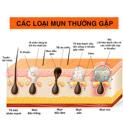 Cách Điều Trị Mụn Hiệu Quả Tại Nhà