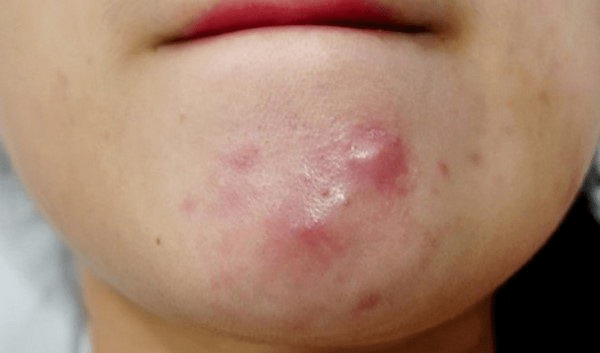 xử l&yacute; mụn bị chai cứng dưới da