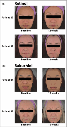 bakuchiol v&agrave; retinol