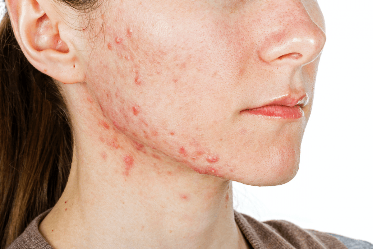 cách trị mụn nội tiết