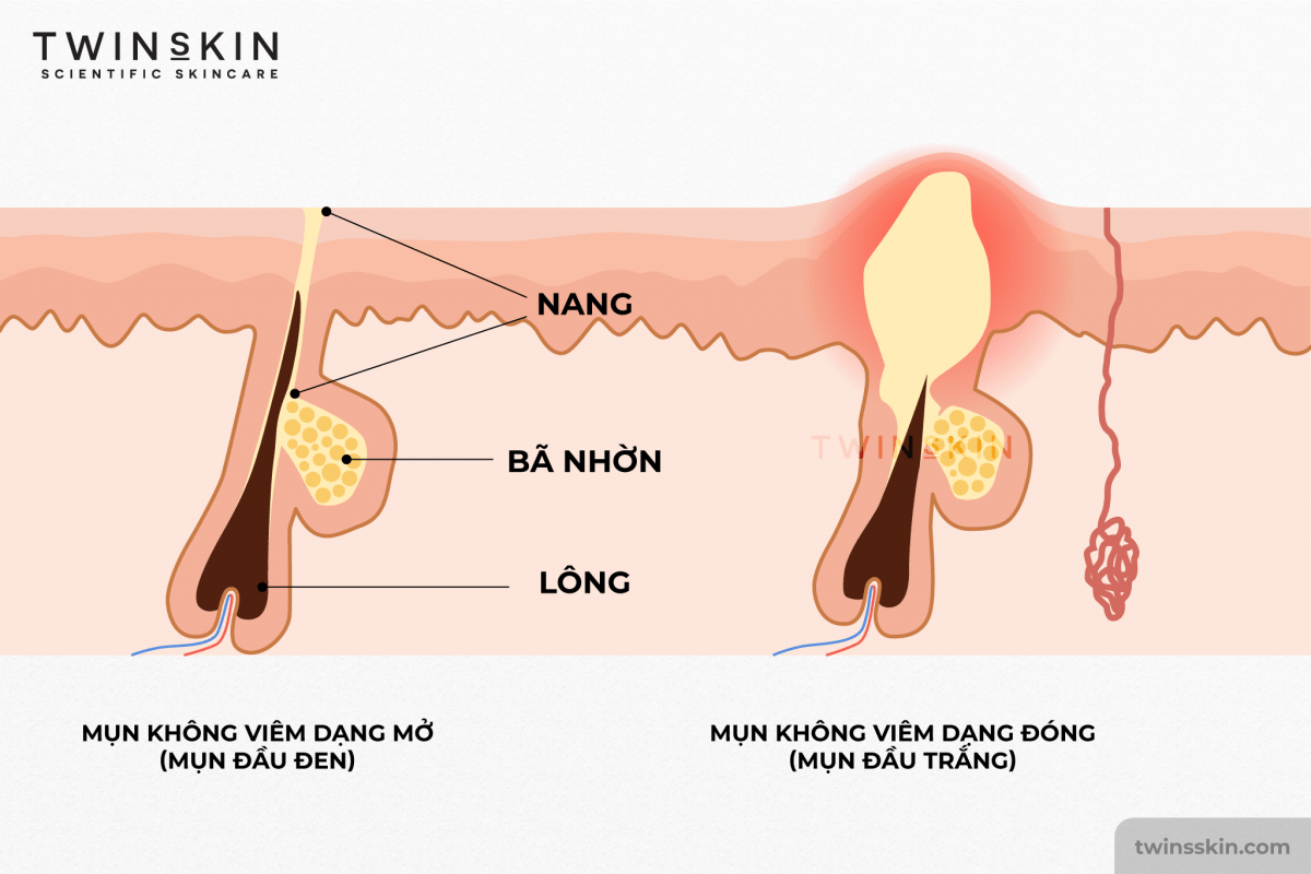 cách trị mụn không viêm