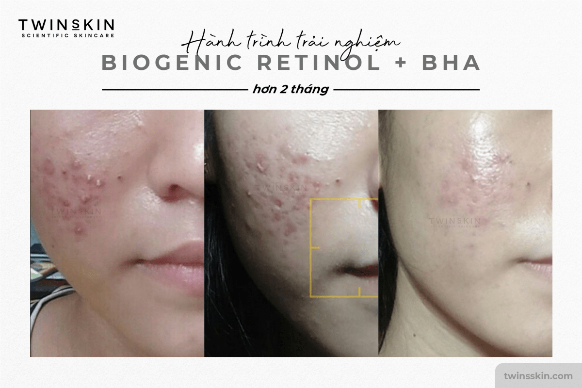 công dụng trị mụn của retinol twins skin