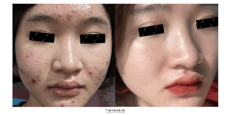 feedback-retinol-tri-mun-khach