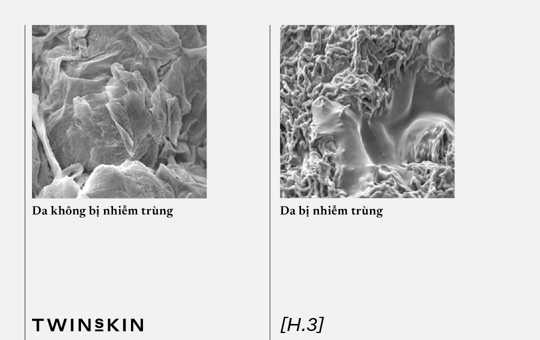 nhiem-trung-viem-sau-xam-lan-da