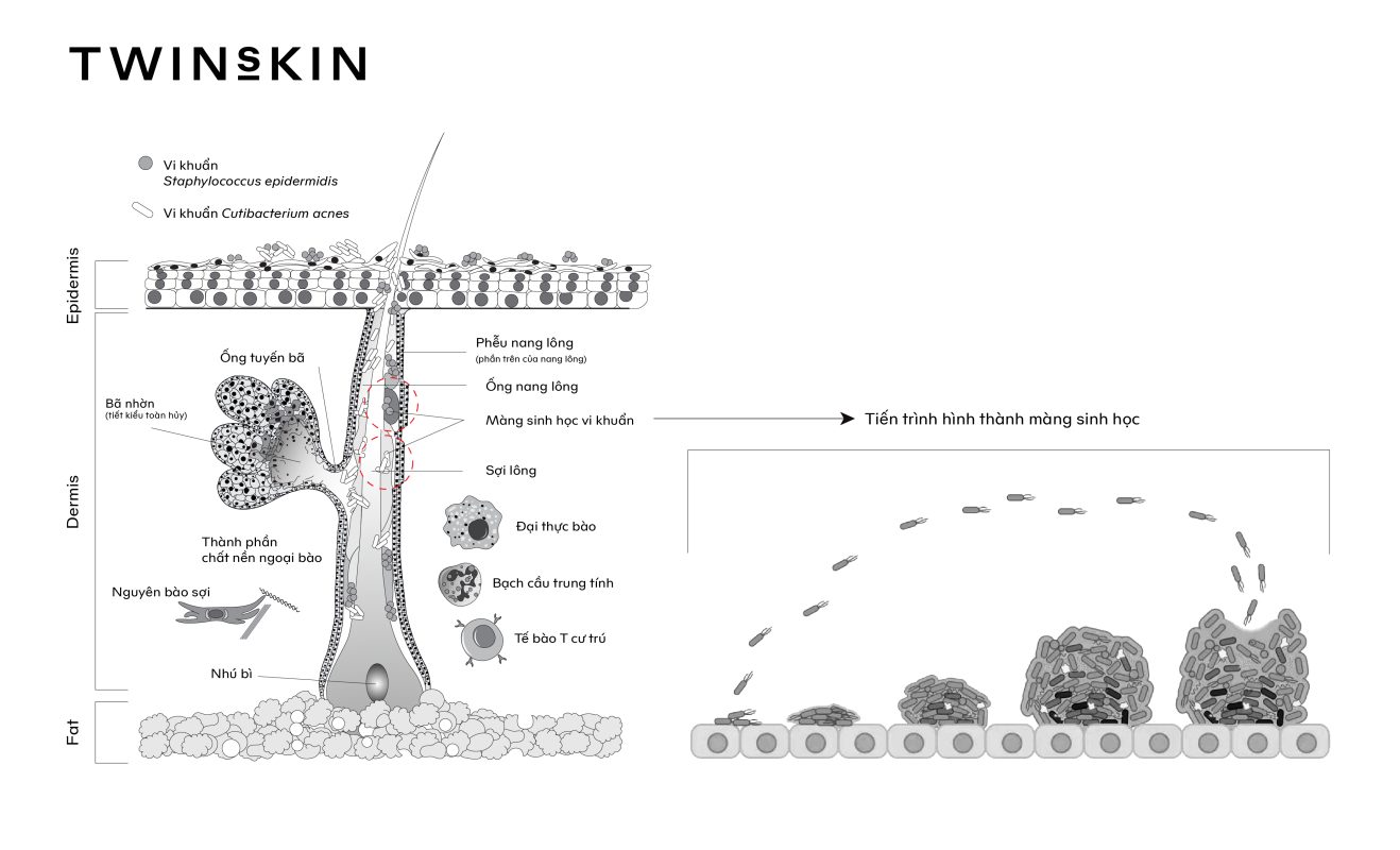 Phân biệt mụn kháng kháng sinh so với mụn trứng cá thông thường