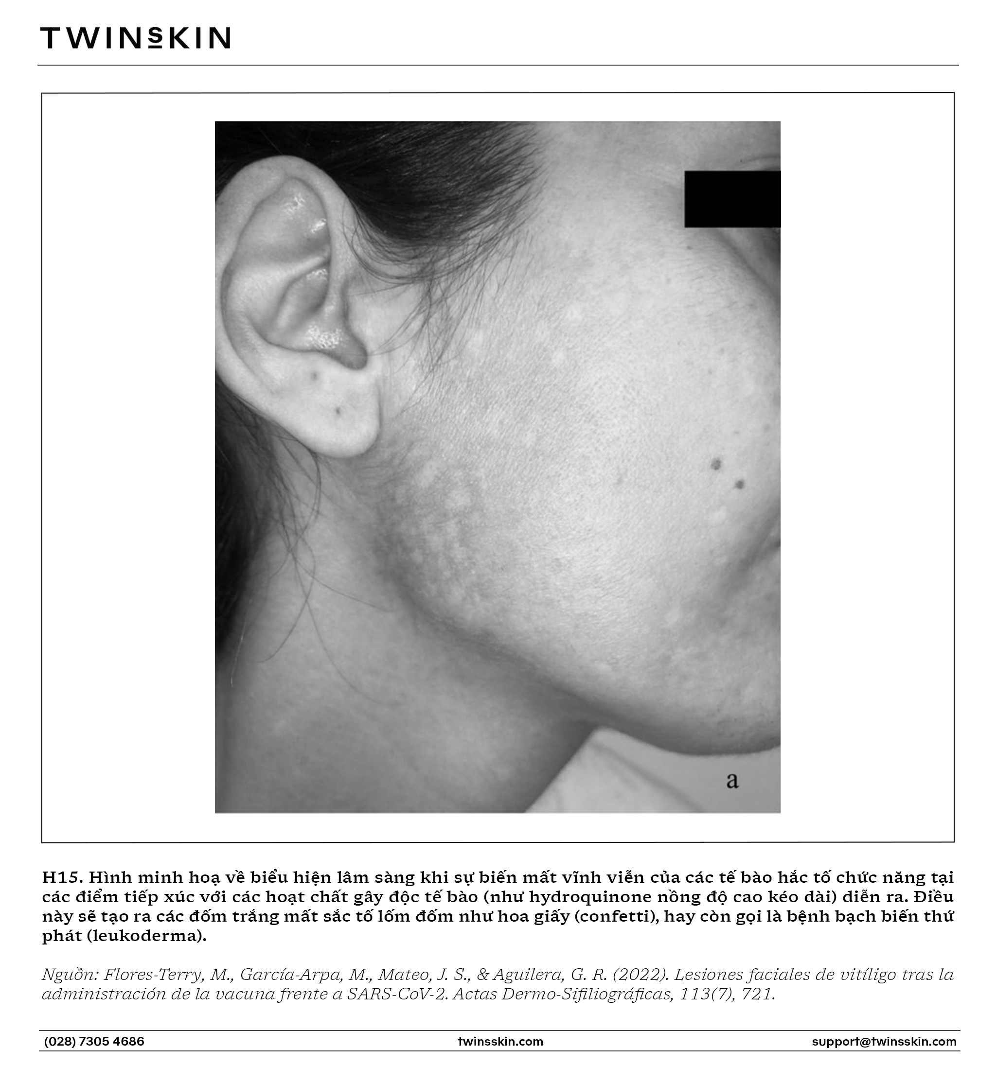 Hệ thống enzyme kích thích sinh nám