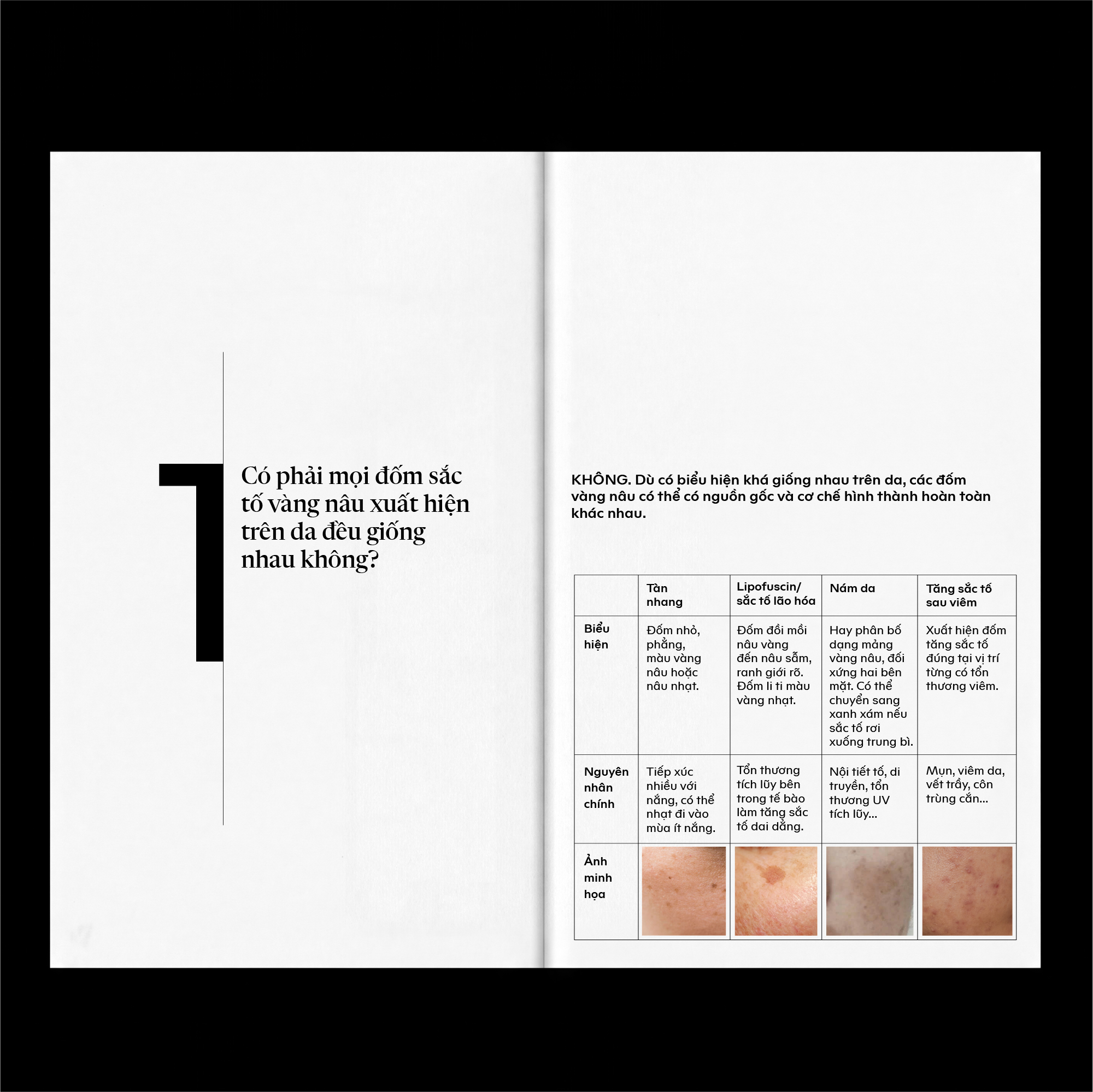 Đốm vàng nâu do lipofuscin tích tụ