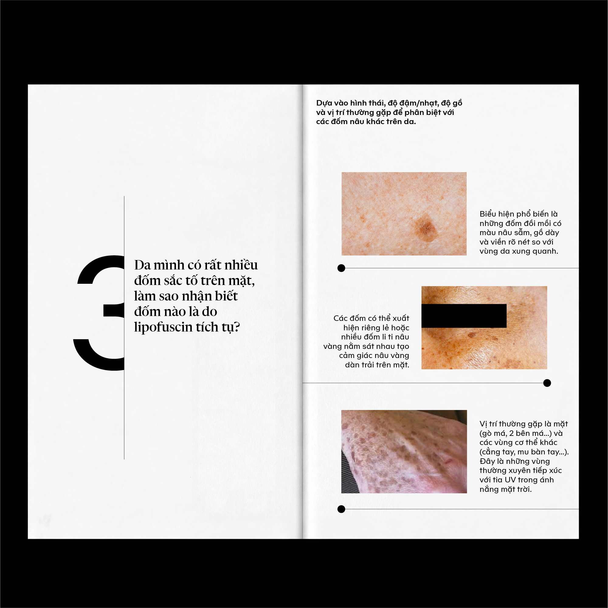 Đốm vàng nâu do lipofuscin tích tụ