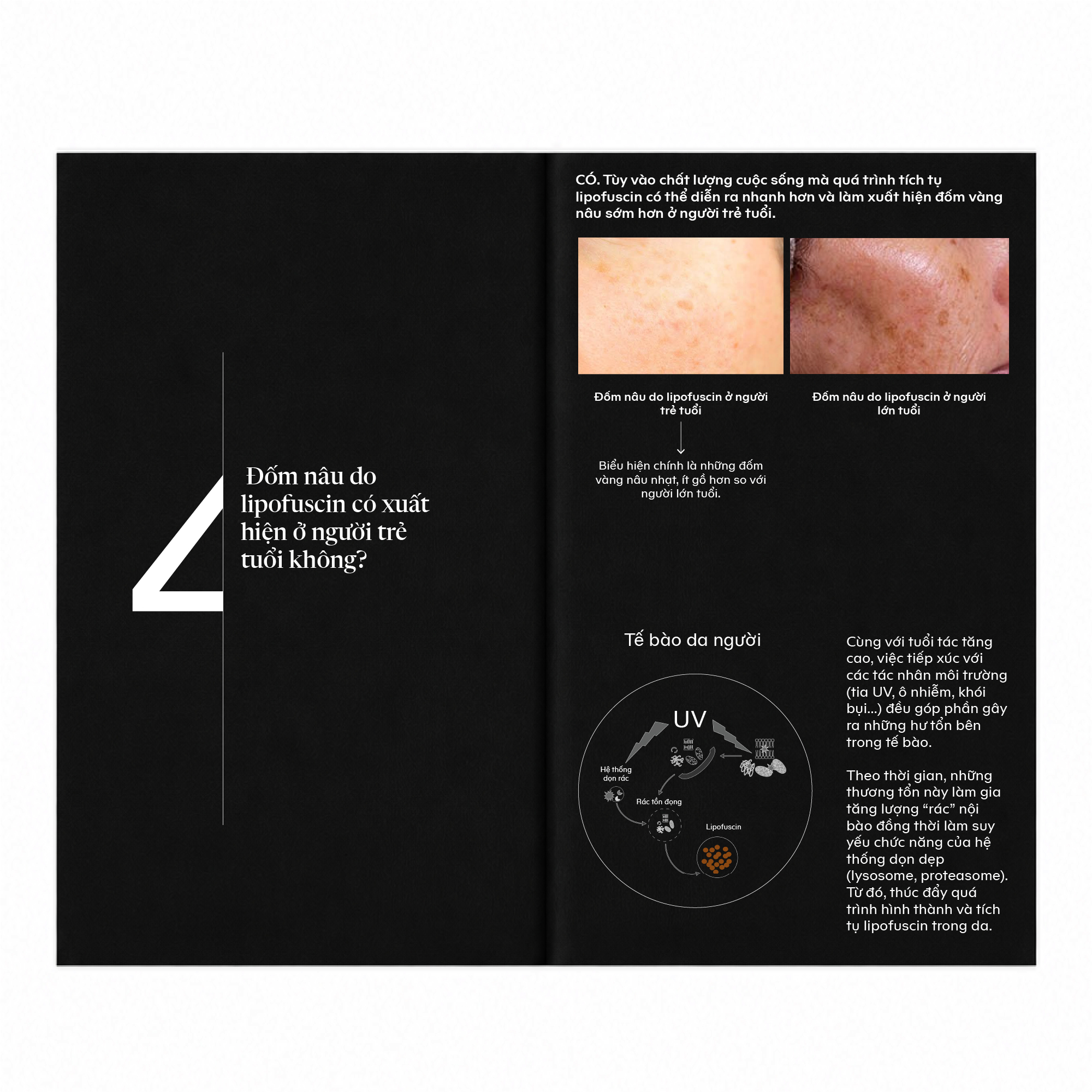 Đốm vàng nâu do lipofuscin tích tụ